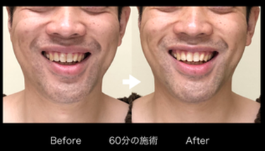 「頬がすっきりしています」男性の声